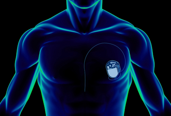 Имплантация электрокардиостимулятора